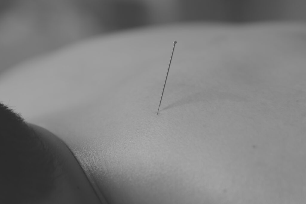 Dry Needling offered at Amend Massage Therapy Preston 2170 NSW.
